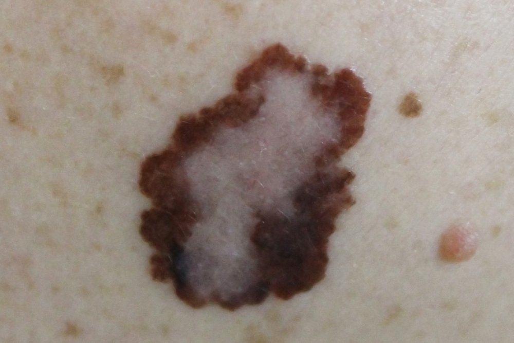 Study reveals potential new treatment for patients with metastatic melanoma