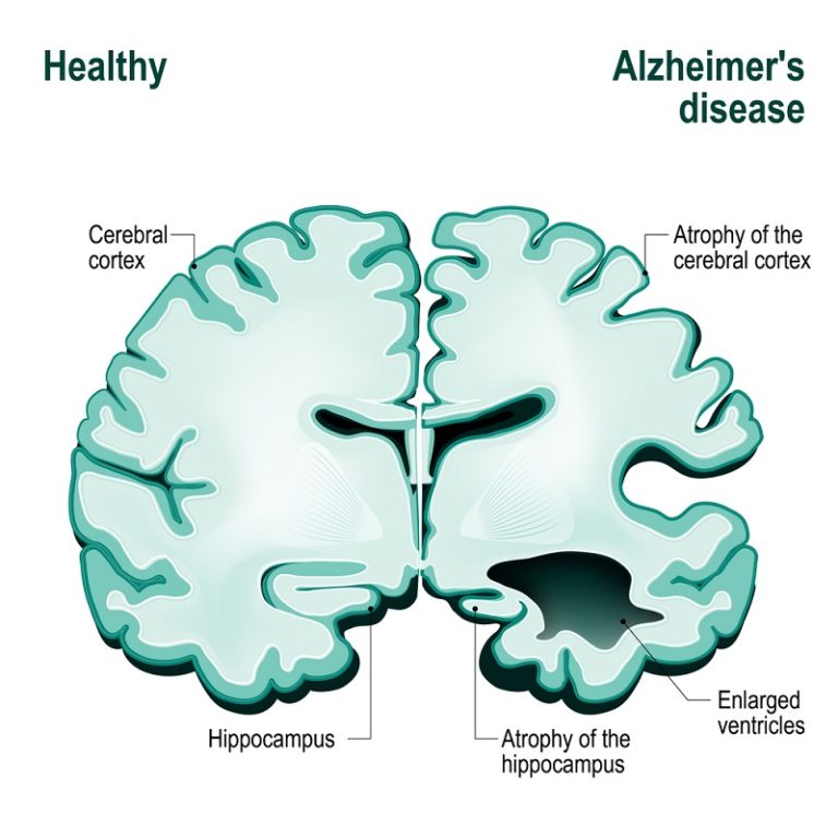 Distinct Types of Amyloidbeta Prion Strains in Alzheimer's Disease