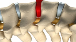 Spinal degradation