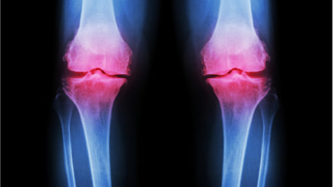Image of knee inflammation caused by osteoarthritis