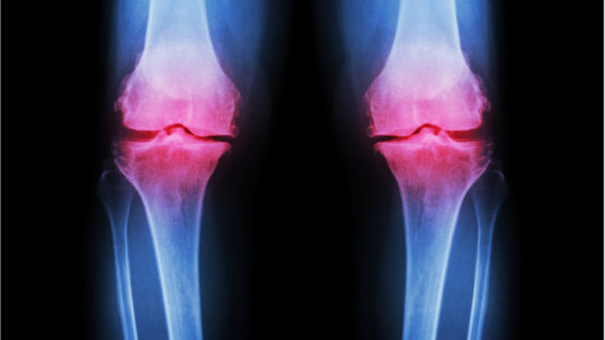 Image of knee inflammation caused by osteoarthritis