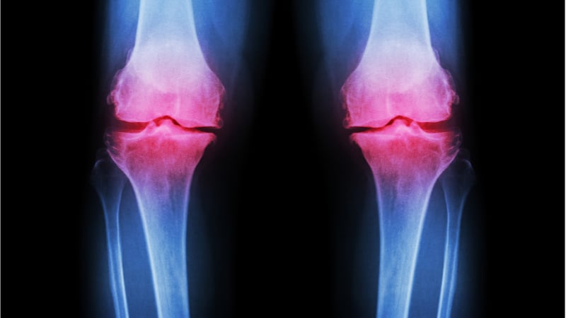 Image of knee inflammation caused by osteoarthritis