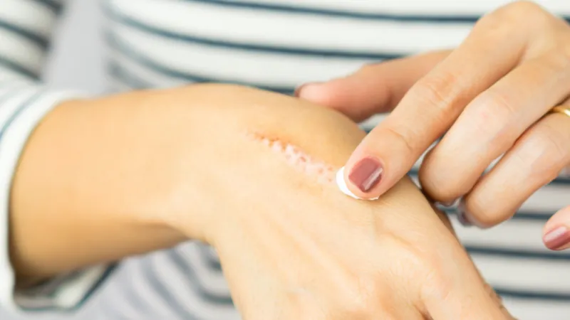 Woman applying topical skin cream