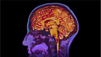 An MRI of the human brain