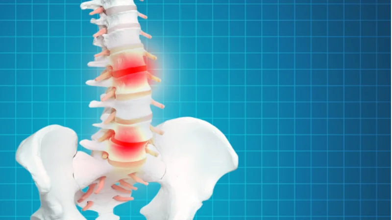 Spinal Disc Degeneration