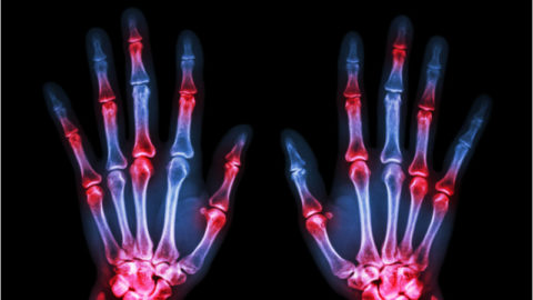 Hand arthritis