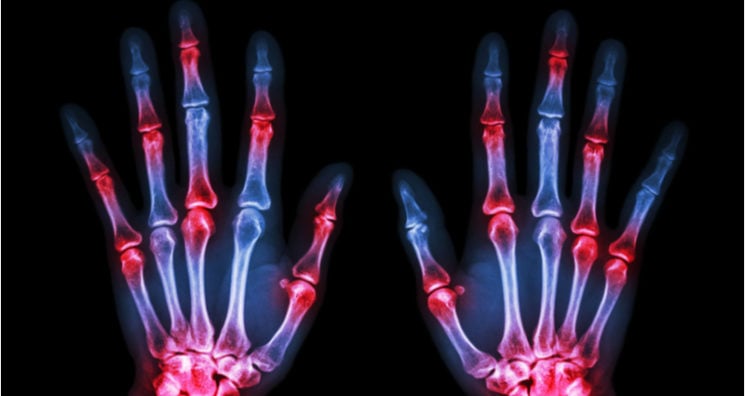 Osteopontin Bone Remodeling May Be Key to Arthritis