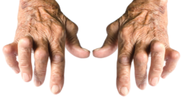 Hand arthritis