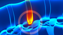 Spinal disc