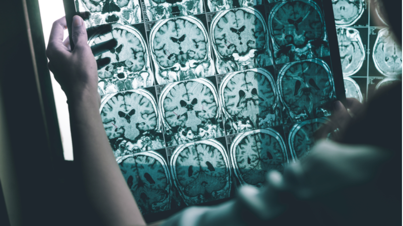 Epigenetic Clock for Brain Age and Alzheimer's | Lifespan.io