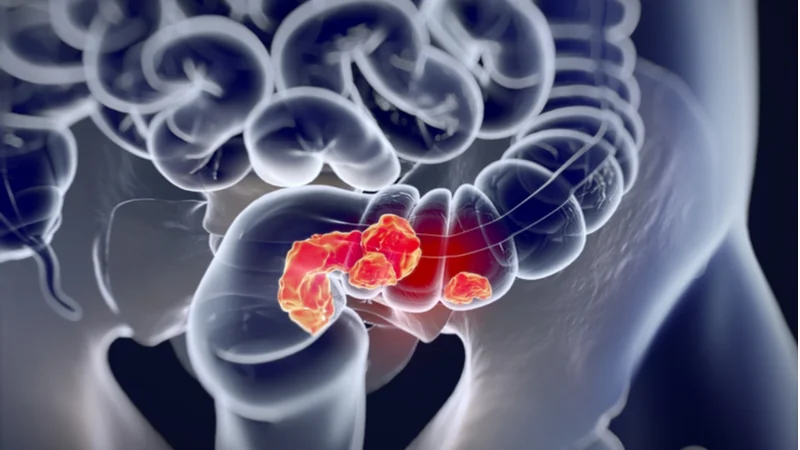 Rectal cancer