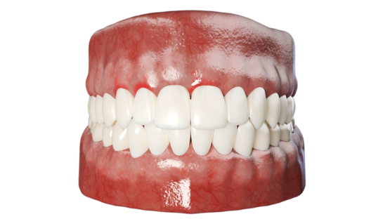Periodontitis