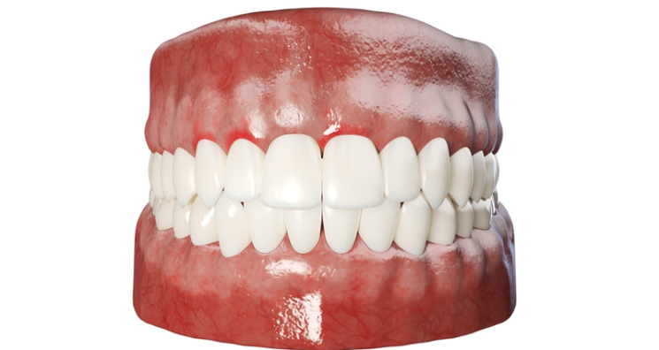 VitaDAO Backs Research into Chronic Oral Disease