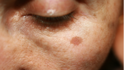 Skin aging