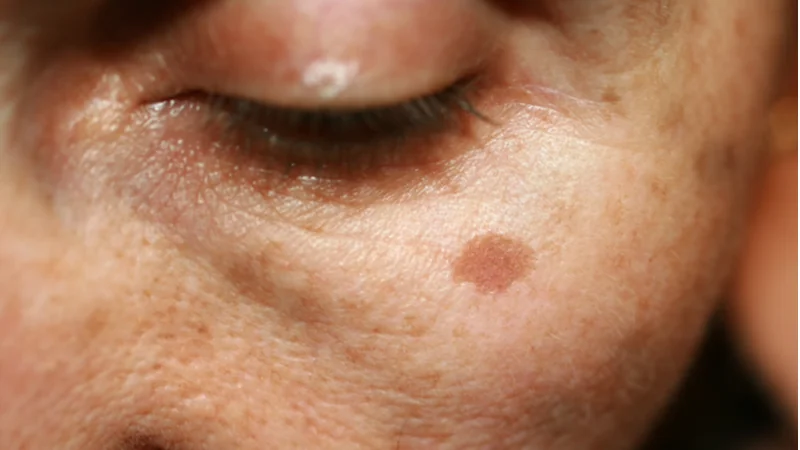 Skin aging