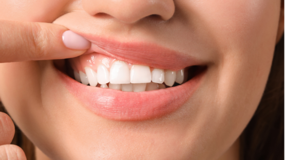 Healthy gums
