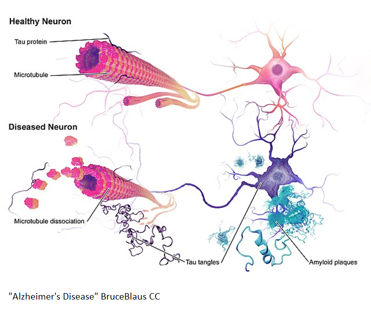 ApoE Alzheimer's 4