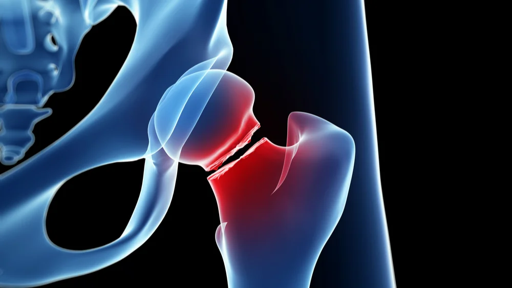 Hip fracture