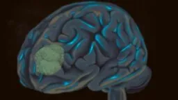 Glioblastoma
