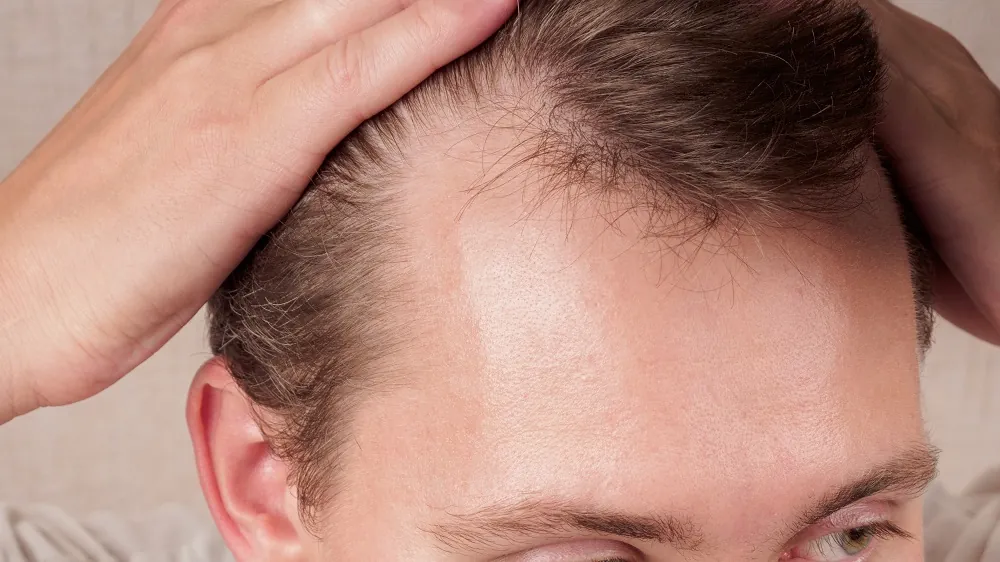 Alopecia