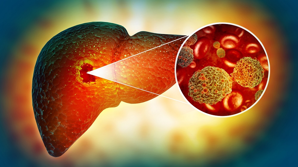 Alcohol Linked to Increased Cancer Risk: New Insights