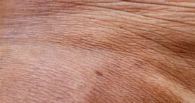 A New Approach to Treating Aging Skin
