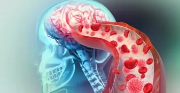 Impaired Brain Blood Flow Might Be Important in Alzheimer’s