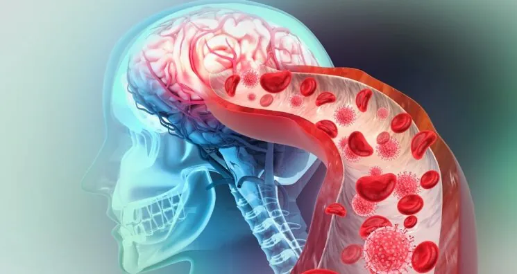 Impaired Brain Blood Flow Might Be Important in Alzheimer’s