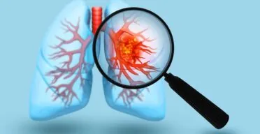 Mitochondria Transplant Improves Chemotherapy in Lung Cancer