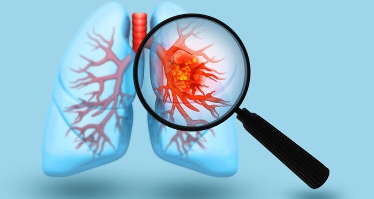 Mitochondria Transplant Improves Chemotherapy in Lung Cancer