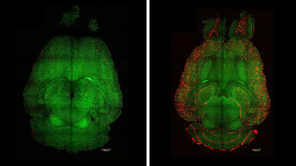 Nanoparticles Alzheimer's