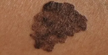 How Senescent Cells Encourage Melanoma Growth