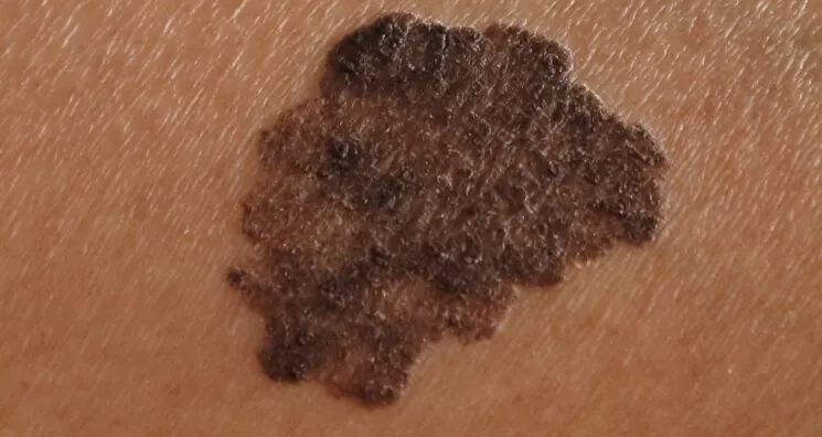 How Senescent Cells Encourage Melanoma Growth