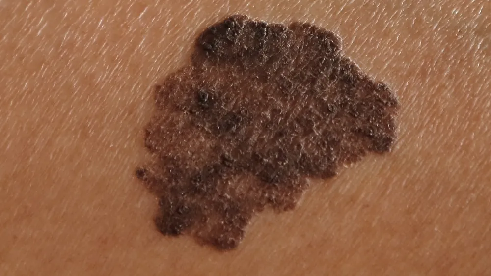 Melanoma