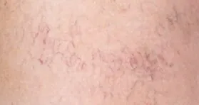 Skin Aging Underlined by Loss of Capillary Macrophages