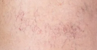 Skin Aging Underlined by Loss of Capillary Macrophages