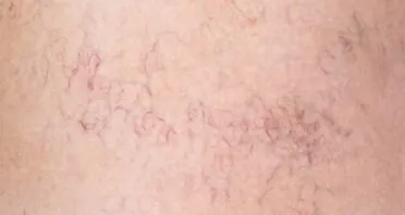 Skin Aging Underlined by Loss of Capillary Macrophages