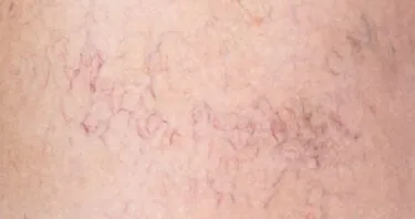 Skin Aging Underlined by Loss of Capillary Macrophages