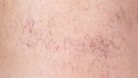 Skin capillaries