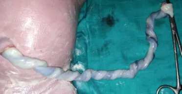 Human Umbilical Cord Blood Metabolites Lengthen Worms’ Lives