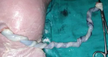 Human Umbilical Cord Blood Metabolites Lengthen Worms’ Lives