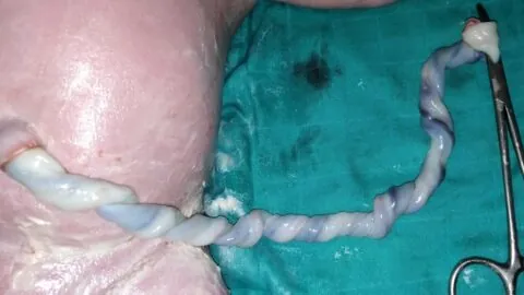 Umbilical cord