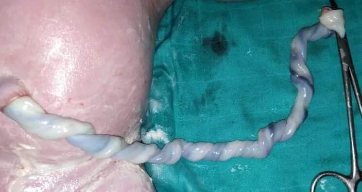 Human Umbilical Cord Blood Metabolites Lengthen Worms’ Lives