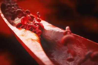 Clogged artery