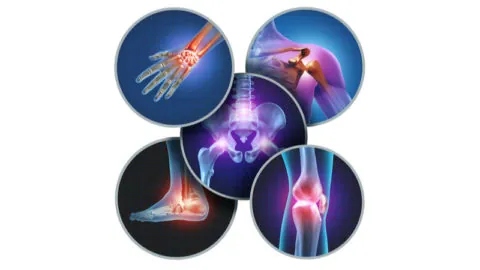 Arthritic joint pain