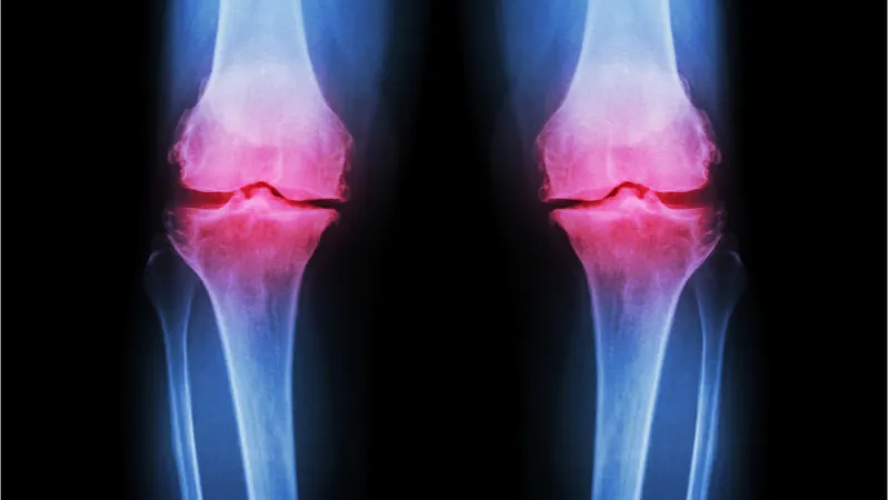 Image of knee inflammation caused by osteoarthritis