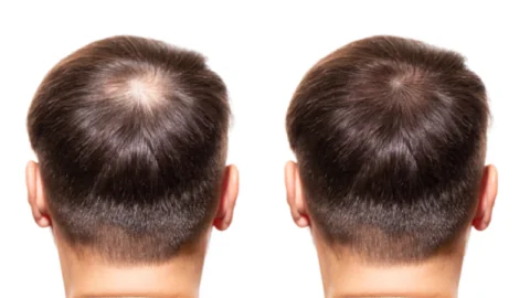 Hair Loss and Regrowth