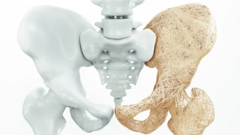 Hip osteoporosis