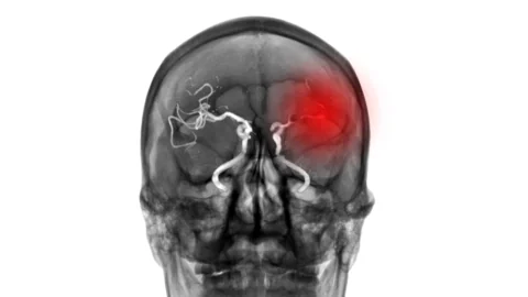 Ischemic stroke