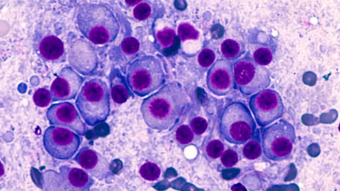 Multiple myeloma